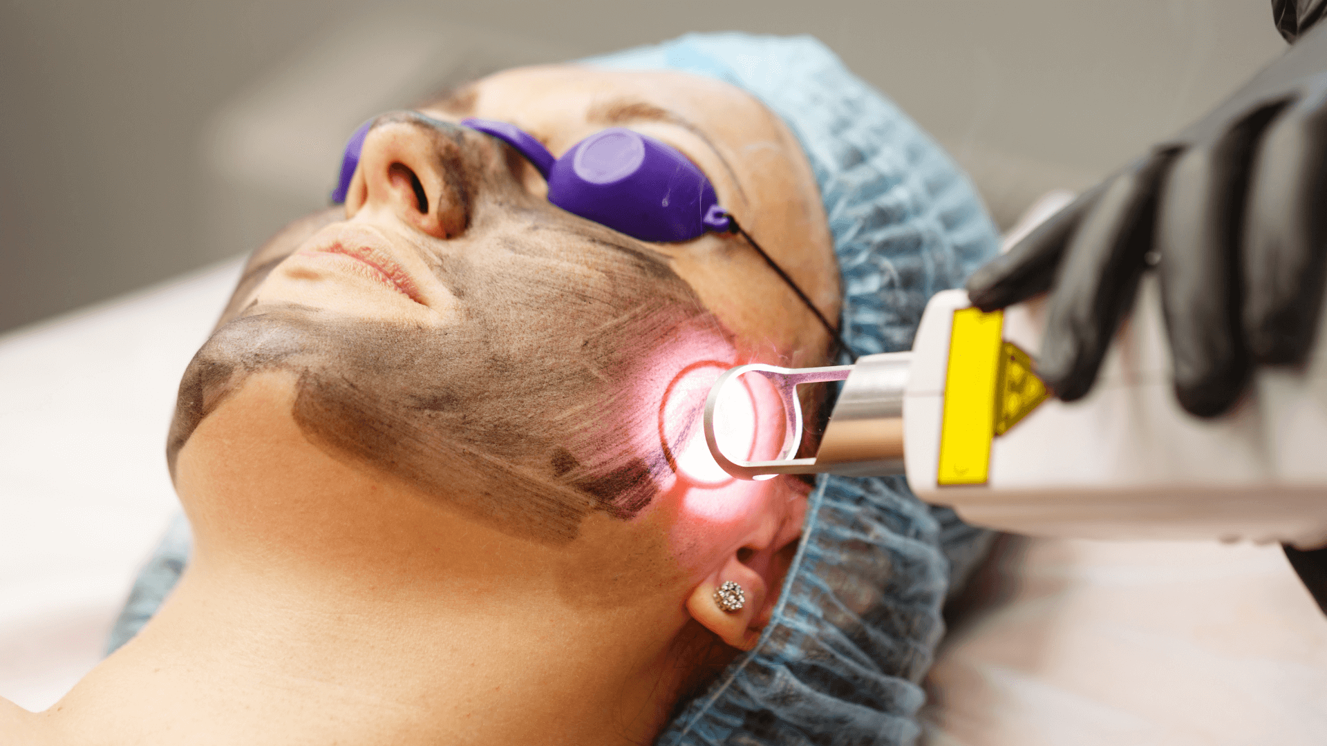 Peeling Hollwood Toledo